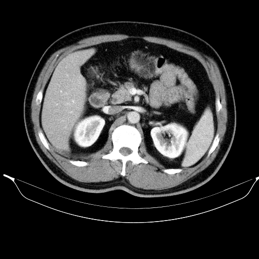 Colonic lipoma with colo-colic intussusception (Radiopaedia 58944-66200 A 21).jpg