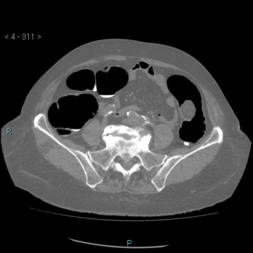 Colonic lipomas (Radiopaedia 49137-54244 Axial bone window 139).jpg