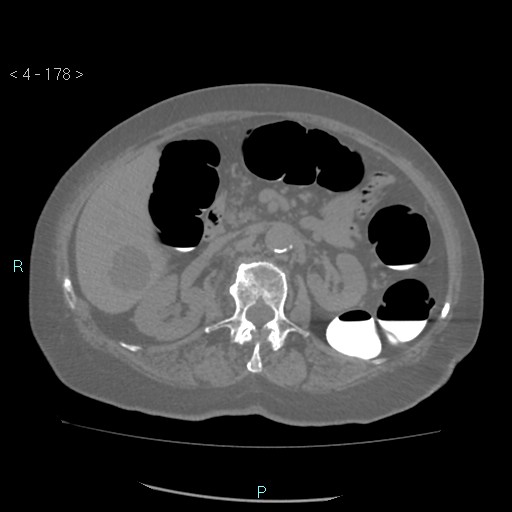 File:Colonic lipomas (Radiopaedia 49137-54244 Axial bone window 80).jpg