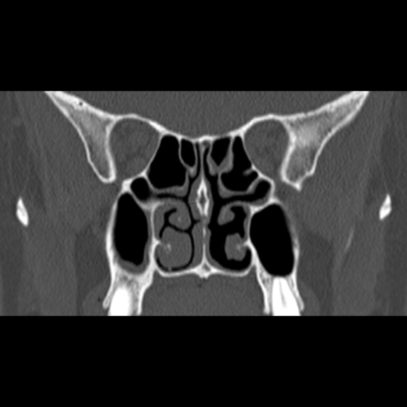 Nasal septal perforation (Radiopaedia 25030-25289 Coronal bone window 44).jpg