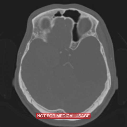 File:Nasopharyngeal carcinoma recurrence - skull base destruction (Radiopaedia 29107-29490 Axial bone window 67).jpg