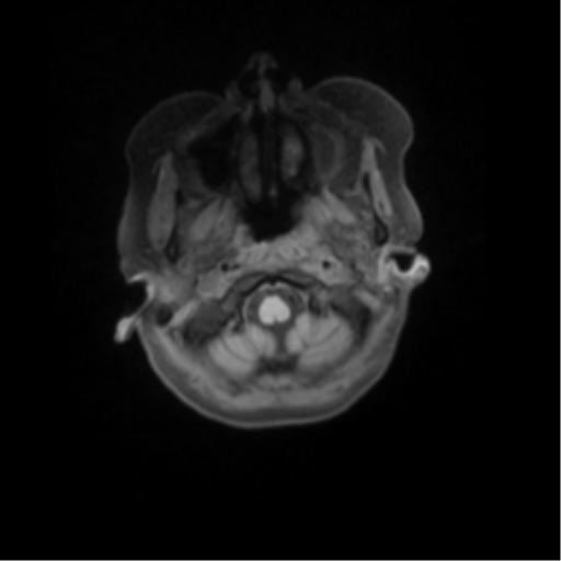 File:Nasopharyngeal carcinoma with cerebral abscess (Radiopaedia 43018-46274 Axial T1 fat sat 8).png