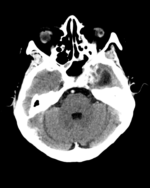 Nasopharyngeal carcinoma with cerebral abscess (Radiopaedia 43018-46275 Axial C+ delayed 16).png