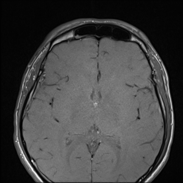 File:Nasopharyngeal carcinoma with skull base invasion (Radiopaedia 53415-59485 Axial T1 8).jpg