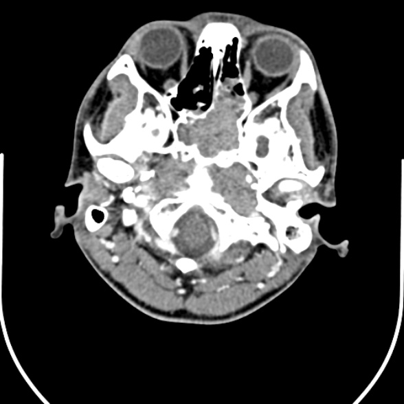 Nasopharyngeal carcinoma with skull base invasion (Radiopaedia 53415-59705 A 27).jpg
