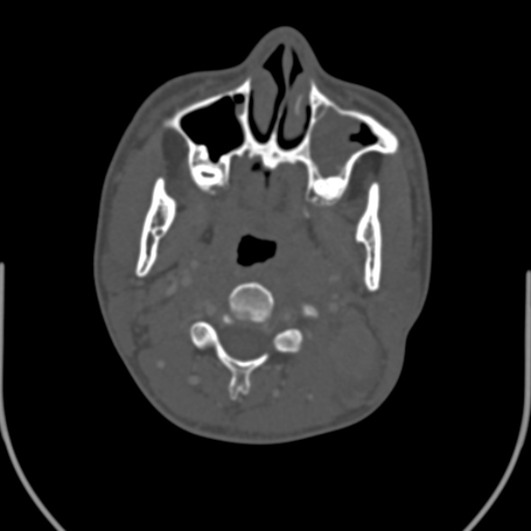 Nasopharyngeal carcinoma with skull base invasion (Radiopaedia 53415-59705 Axial bone window 75).jpg