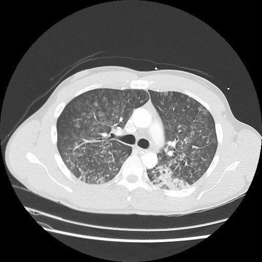 Near-drowning pulmonary edema (Radiopaedia 59457-66814 Axial lung window 22).jpg