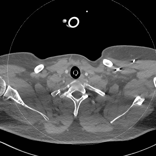 Neck CT angiogram (intraosseous vascular access) (Radiopaedia 55481-61945 B 114).jpg