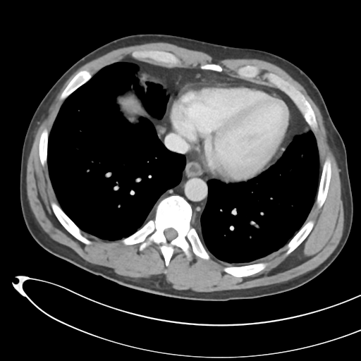 File:Necrotizing pancreatitis with acute necrotic collections (Radiopaedia 38829-41012 B 6).png
