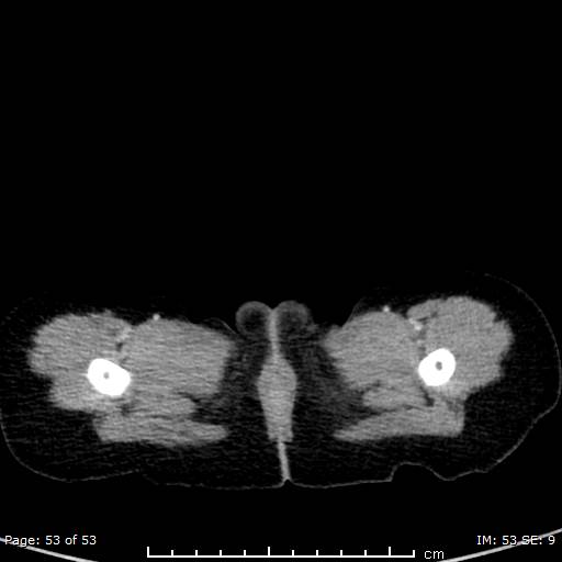 Nephroblastomatosis (Radiopaedia 41934-44935 A 53).jpg