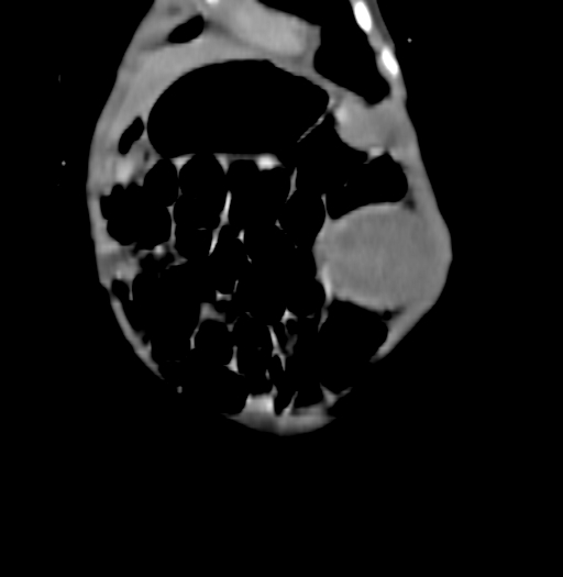 Nephroblastomatosis (Radiopaedia 71294-81607 B 59).jpg