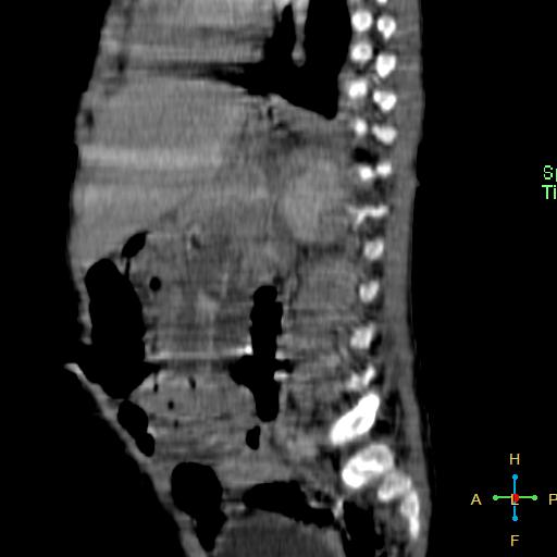 File:Neuroblastoma (Radiopaedia 24751-25016 C 11).jpg