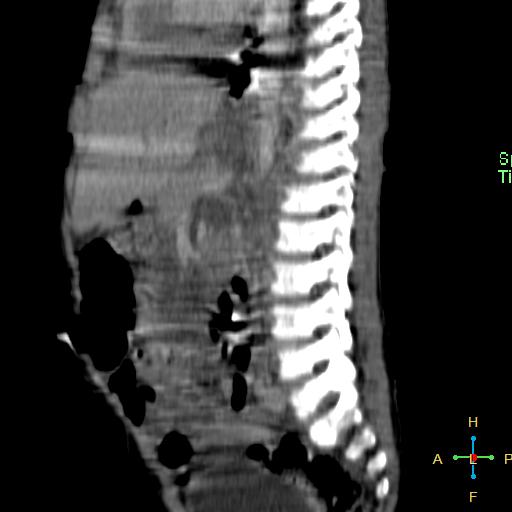 File:Neuroblastoma (Radiopaedia 24751-25016 C 12).jpg