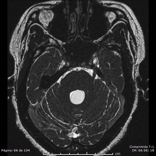 Neurocysticercosis (Radiopaedia 58636-65832 I 66).jpg