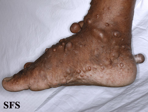 File:Neurofibromatosis (Dermatology Atlas 67).jpg