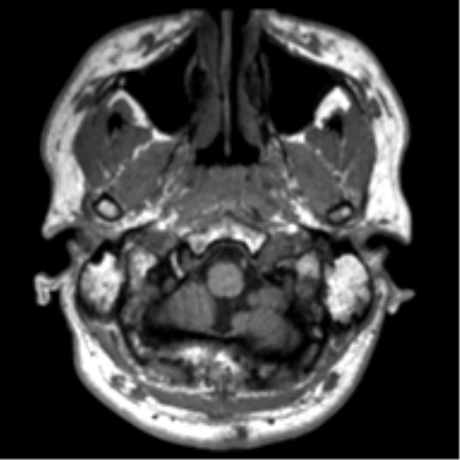 File:Neurofibromatosis type 2 (Radiopaedia 44936-48838 Axial T1 7).png