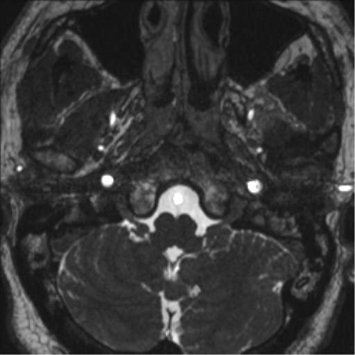 Neurofibromatosis type 2 (Radiopaedia 44936-48838 E 11).png