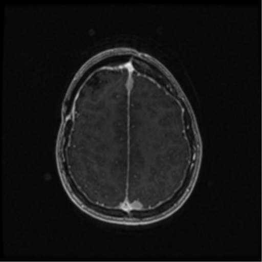 Neurofibromatosis type 2 (Radiopaedia 45229-49244 Axial T1 C+ 89).png
