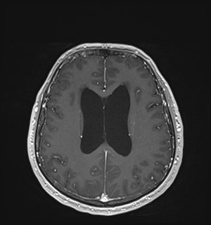 Neurofibromatosis type 2 (Radiopaedia 79097-92049 Axial T1 C+ 128).jpg
