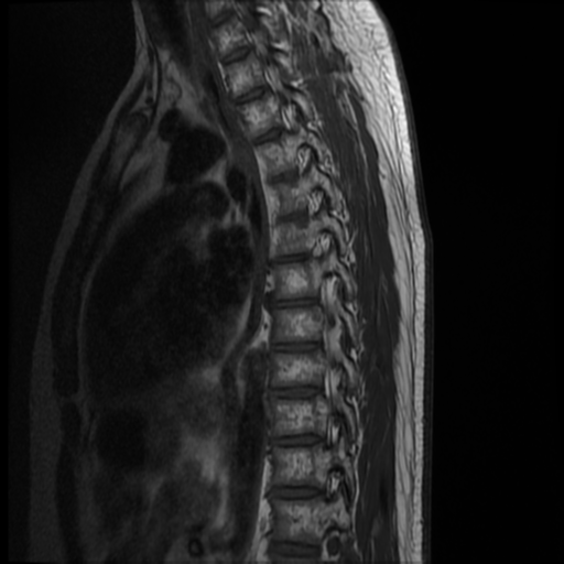 File:Neurofibromatosis type 2 (spinal manifestations) (Radiopaedia 53943-60070 D 5).png