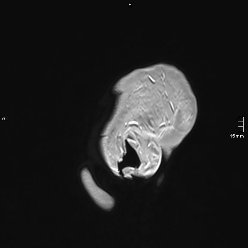 Neurosarcoidosis - involvement of the mesial temporal lobes (Radiopaedia 67429-76820 Sagittal T1 C+ 168).jpg