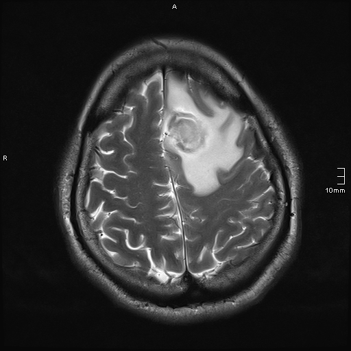 File:Neurotoxoplasmosis - concentric target sign (Radiopaedia 70644-80784 Axial T2 17).jpg