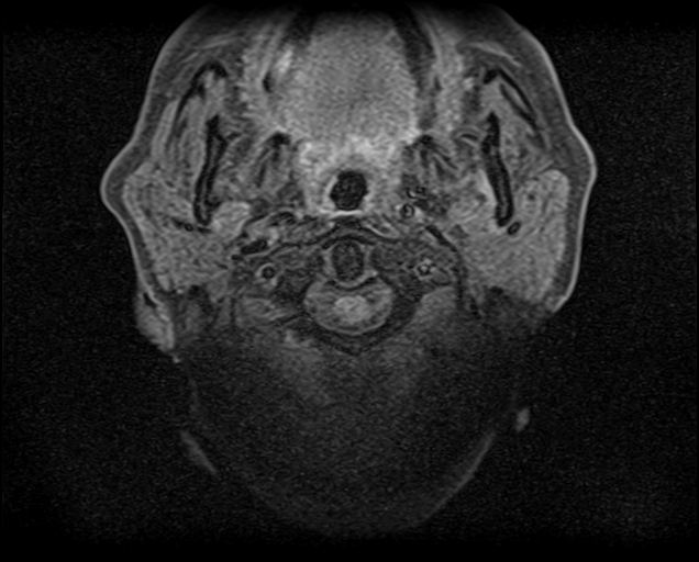 File:Non-Hodgkin lymphoma - parotid gland (Radiopaedia 71531-81890 T1 fat sat 15).jpg