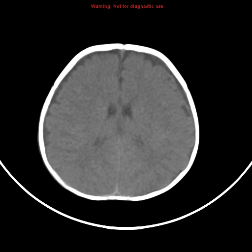 File:Non-accidental injury - bilateral subdural with acute blood (Radiopaedia 10236-10765 Axial non-contrast 14).jpg