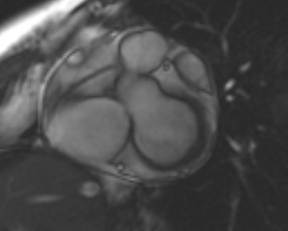 File:Non-compaction of the left ventricle (Radiopaedia 69436-79314 Short axis cine 187).jpg