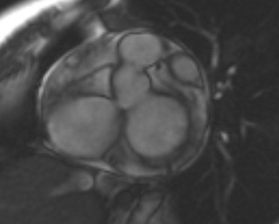 File:Non-compaction of the left ventricle (Radiopaedia 69436-79314 Short axis cine 210).jpg