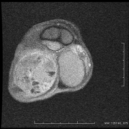 File:Non-seminomatous germ cell tumor (Radiopaedia 16649-16352 Coronal T1 C+ 3).png