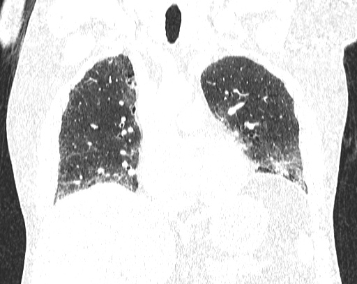 Non-specific interstitial pneumonia (NSIP) (Radiopaedia 68599-78228 Coronal lung window 39).jpg
