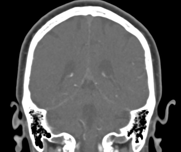 File:Normal CTA head (Radiopaedia 40801-43464 B 66).png