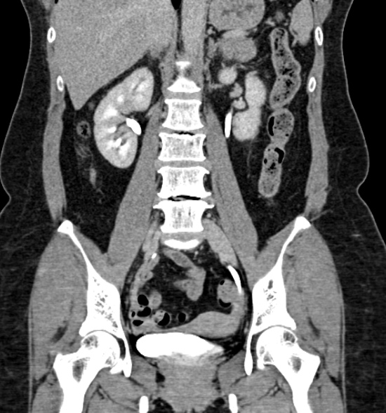 Normal CT intravenous urogram (Radiopaedia 39444-41759 A 285).jpg