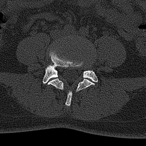 File:Normal CT lumbar spine (Radiopaedia 53981-60118 Axial bone window 53).jpg