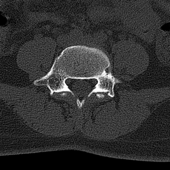 File:Normal CT lumbar spine (Radiopaedia 53981-60118 Axial bone window 55).jpg