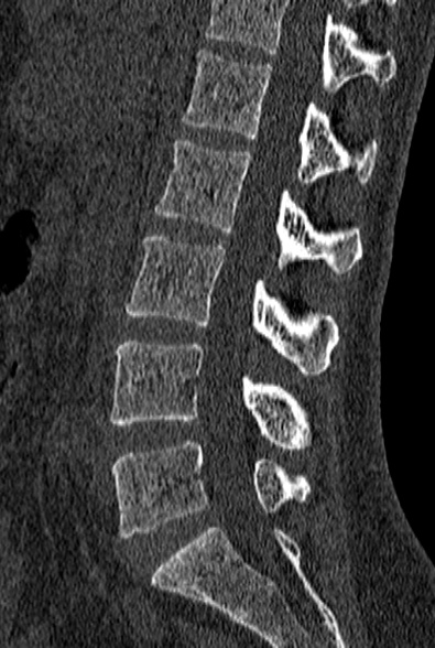 File:Normal CT lumbar spine (Radiopaedia 53981-60118 Sagittal bone window 47).jpg
