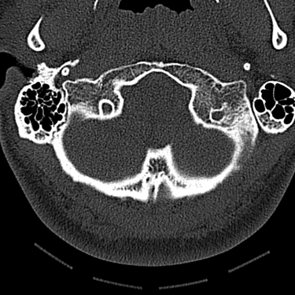 Normal CT of the cervical spine (Radiopaedia 53322-59305 Axial bone window 36).jpg