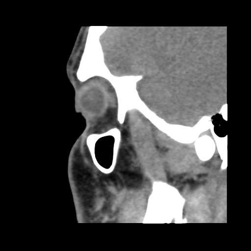 Normal CT paranasal sinuses (Radiopaedia 42286-45390 F 117).jpg