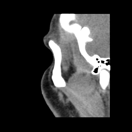 Normal CT paranasal sinuses (Radiopaedia 42286-45390 F 129).jpg