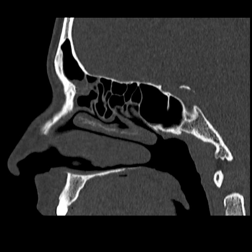 Normal CT paranasal sinuses (Radiopaedia 42286-45390 Sagittal bone window 58).jpg