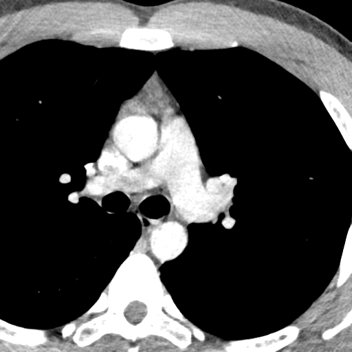 File:Normal CT pulmonary veins (pre RF ablation) (Radiopaedia 41748-44702 A 55).png