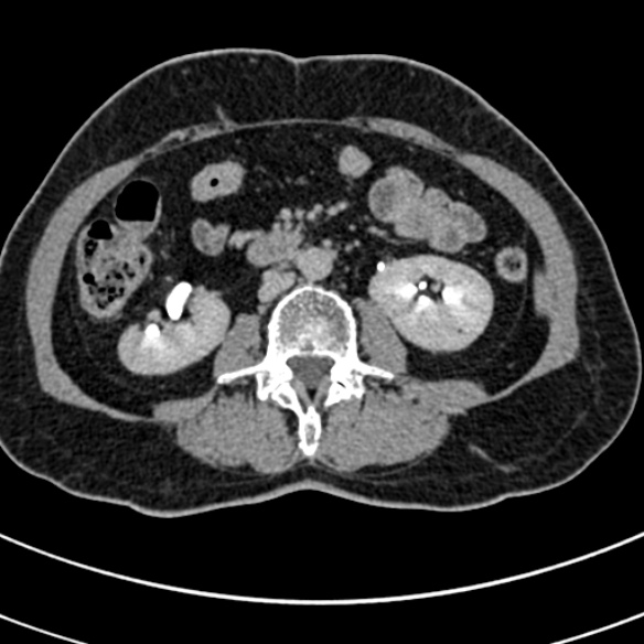 File:Normal CT split bolus study of the renal tract (Radiopaedia 48631-53634 Axial split bolus 122).jpg