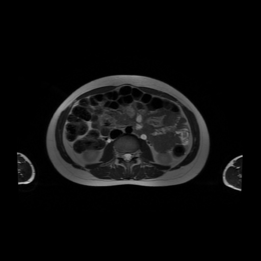 File:Normal MRI abdomen in pregnancy (Radiopaedia 88001-104541 Axial T2 32).jpg