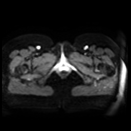 Normal MRI abdomen in pregnancy (Radiopaedia 88005-104548 Axial DWI 4).jpg