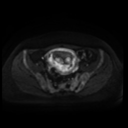 Normal MRI abdomen in pregnancy (Radiopaedia 88005-104548 Axial DWI 59).jpg