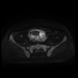 Normal MRI abdomen in pregnancy (Radiopaedia 88005-104548 Axial DWI 99).jpg
