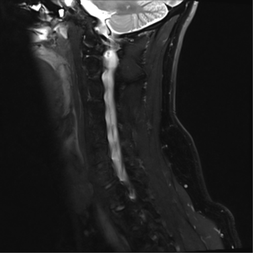 File:Normal MRI cervical spine (infection protocol) (Radiopaedia 53916-60039 Sagittal Dixon 5).png