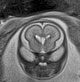 Normal brain fetal MRI - 22 weeks (Radiopaedia 50623-56050 Coronal T2 Haste 16).jpg