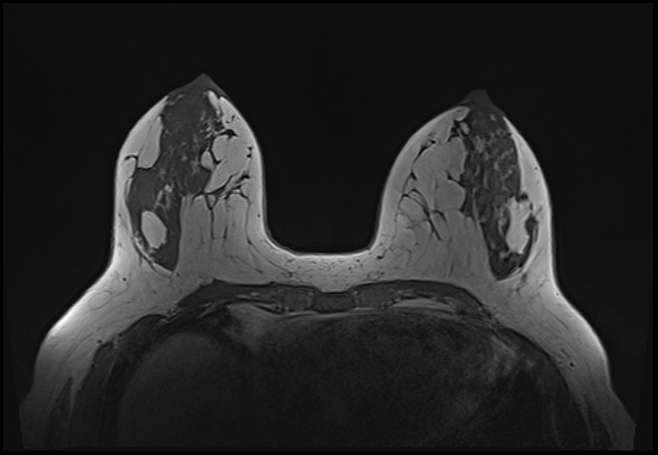 File:Normal breast MRI - dense breasts (Radiopaedia 80454-93850 Axial T1 92).jpg